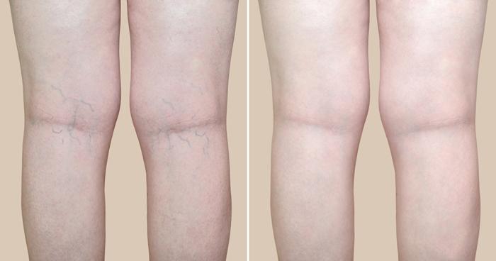 Before and after of microsclerotherapy