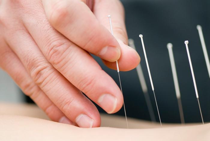 Close up of someone placing acupuncture needles